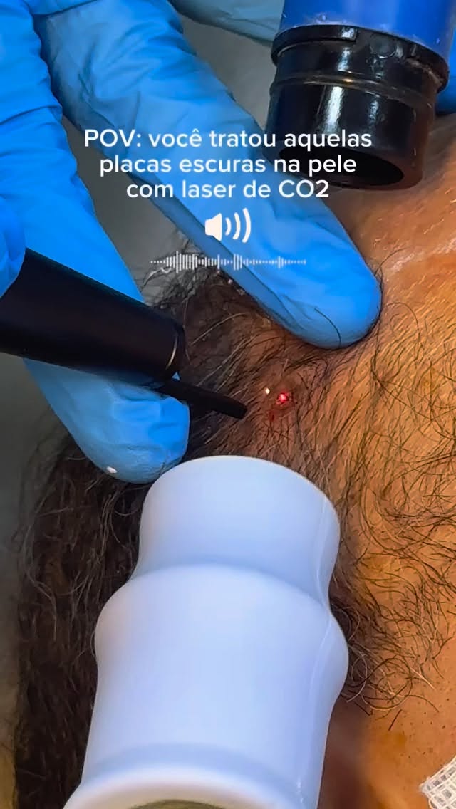 POV: você tratou aquelas placas escuras na pele com laser de CO2.
E, na realidade, essas placas escuras podem ser queratoses seborreicas.
Elas são tumores cutâneos benignos (não cancerígeno), muito comum com o envelhecimento, caracterizados por lesões verrucosas, “coladas” na pele, com cores que variam do castanho claro ao preto.
Afetam principalmente tronco e face, é indolor, não contagiosas e, geralmente, tratadas por motivos estéticos ou irritação.
Dr Emmanuel França
Dermatologista
CRM 5999
RQE 636
📍Skin Prime - Riomar Trade Center - Torre 3 - Sala 1905
☎️ (81) 3036-4040