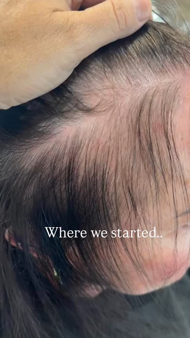 Calecim PTT-6 Hair Loss System
The reason I love this product, is because of the honesty of the real results.
Not only do we see amazing results in our clinic, but if you check out @calecimprofessional you will see honest, true and realistic results- not fake gimmicks.
We stock this miracle product in our clinic- send us a DM to learn more!
#wollongonghairreplacement #Illawarrahairloss #womenshairloss #trichologyclinic