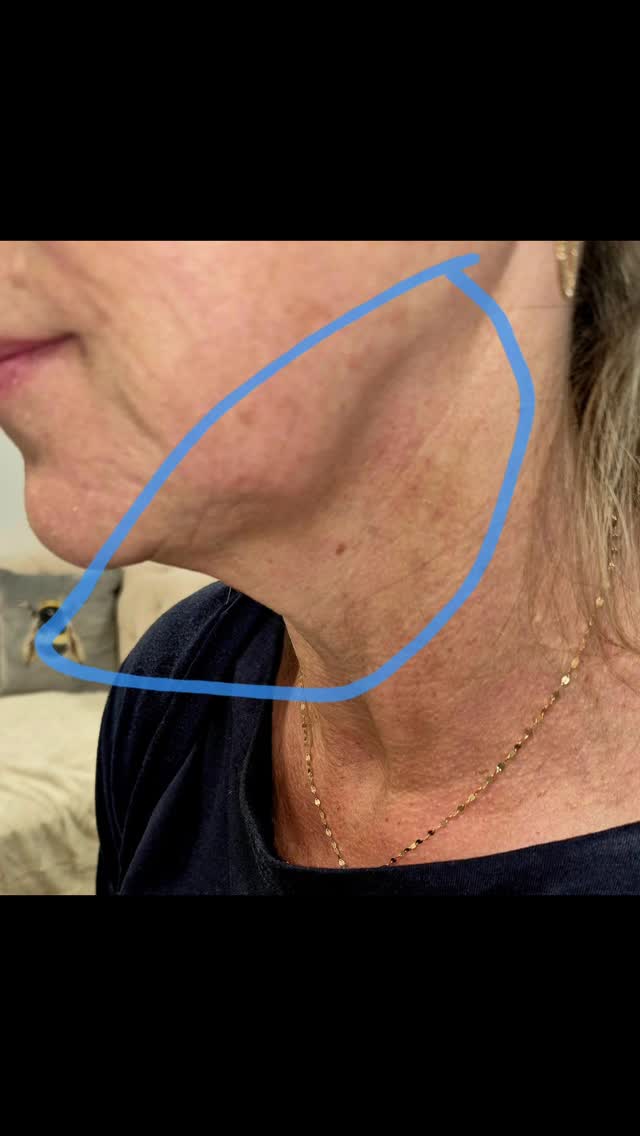 Possibly thinking of hopping on a plane for a facelift? ✈️ Maybe for now...
Hit.
Pause.
Before the surgery, the downtime, and the drama… try the lift that’s got everyone rethinking it.
Cog threads = instant snatch, sculpted jawline, tighter neck — no scalpel required.
Upgrade first… you might not need the flight 😉
#cogthreadtransformation #necklift #jowllift #snatchedjawline #necktightening