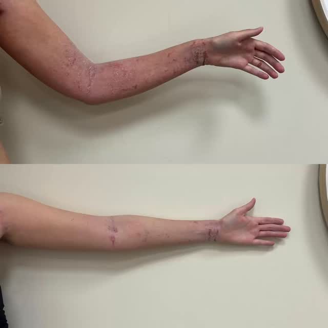 När huden gör ont att röra vid blir varje rörelse en kamp.
Vid första besöket kunde kunden inte ens sträcka ut armarna.
Efter endast 2 CAP-behandlingar ser vi lugnare hud och mycket bättre rörlighet ❤️
#capbehandling #coldatmosphericplasma #hudhälsa #malmö #kista