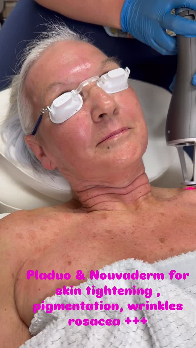 ✨ Real Patient. Real Experience. Real Glow. ✨
“Honestly, I was nervous at first… but it was way easier than I expected.” 💬
Today we combined Pladuo + NouvaDerm for the ultimate skin reset—and here’s what our patient had to say👇
💖 “It felt warm, not painful… almost like a tightening sensation. I could literally feel my skin working.”
✨ Pladuo works on a deeper level to tighten, target redness, and improve overall skin texture—perfect for things like rosacea and laxity.
✨ NouvaDerm enhances the surface—boosting glow, refining pores, and giving that smooth, refreshed finish.
Together? 🔥 The perfect combo for firmer, brighter, healthier-looking skin—without the downtime you’d expect.
💬 “My skin already looks clearer and tighter… I’m obsessed.”
If you’ve been wanting results you can feel AND see—this is it.
📲 Call or Text 843-418-4422 to book
📍 Dunes Med Spa
#DunesMedSpa #SkinTightening #RosaceaRelief #Pladuo #NouvaDerm SkinRejuvenation GlowUp RealResults AestheticMedicine MyrtleBeachMedSpa