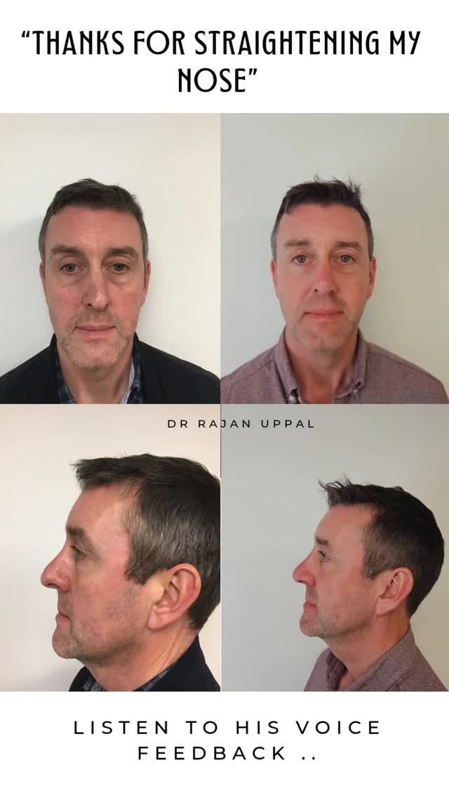 Many thanks for your feedback regarding the bend in your nose due to an injury which was affecting your breathing and the appearance. We're so pleased to hear that you are happy with the results.
Male rhinoplasty is slightly different to female rhinoplasty in that when I do the sculpture I do not want to make the nose too small. We need to maintain the character of the individual.
This is why I spend a lot of time designing the new nose on the computer with the patient, to make sure that what I can deliver, matches what the patient is looking for. In this way we can make sure that patients are happy with the results of their Rhinoplasty surgery.
#beforeandafter #rhinoplasty #plasticsurgeon #nose #nosejob