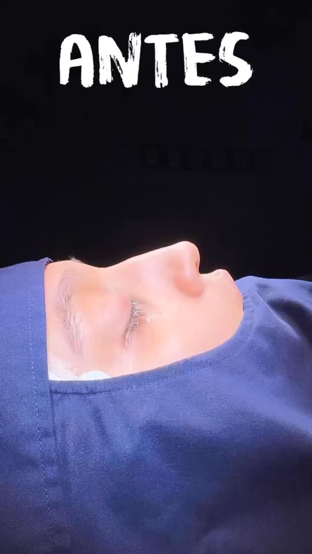 🔹 Con la Rinoplastia personalizada, logramos la forma y el tamaño que mejor complementan tus rasgos, manteniendo la esencia de tu expresión.
🔹Resultado inmediato de Cirugía Nasal Estética y Funcional secundaria con antecedente de cirugía previa.
🔹 Gracias a mi excelente paciente por su confianza y permitir compartir su resultado.
🔹”Made by hand. Crafted with passion”
🧑⚕️ Dr. Guillermo Guerra Gil de Leyva
🏥 Hospital Ángeles Valle Oriente
📱 81-1252-0132
🎓Universidad de Monterrey
👃 Rinoplastia Estética y Funcional
🚫 No taponamiento
Cédula Profesional: 3070499
Cédula Especialista: 4503273
No. Certificación CONACEM: GUG-1748/04
Aviso de Publicidad COFEPRIS: 2419032002A00111
❕Paciente autoriza difusión de imágenes con fines académicos e informativos.
❕Los resultados finales se pudieran observar hasta un año de la cirugía y dependerá tanto del compromiso del cirujano como del paciente, así como del tipo de cirugía, tipo de piel, cuidados post-operatorios, etc.
#TransformacionNatural #EspecialistasEnRinoplastia #PerfilArmonico
#rinoplastia #rhinoplasty septoplasty rinoseptumplastia rhinoseptoplasty nosejob nose nosesurgery tabiquenasal otorrinolaringologia entsurgery cirugianasal cirugiaesteticanasal
belleza confianza autoestima
cosmeticsurgery
otorrinolaringologiamonterrey otorrinomonterrey beforeandafter antesydespues