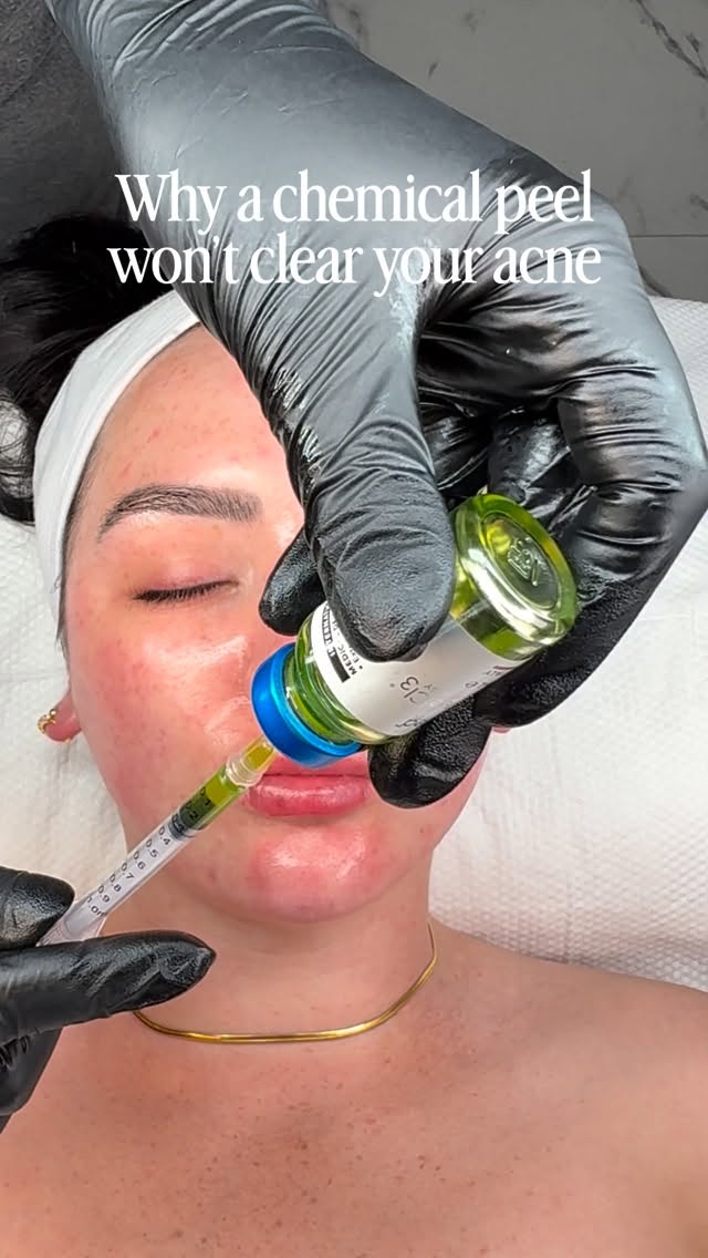 A chemical peel alone is not going to clear your acne if the internal drivers are still being ignored 👀
Because acne is not just a superficial skin condition.
Yes, congestion, excess oil production and follicular build-up show up on the skin, but the ROOT cause is often much deeper 🧬
‼️ Chronic stress elevates cortisol and increases inflammation.
🛌 Poor sleep impacts skin healing and hormone regulation.
🦠 Gut dysfunction can influence inflammation pathways and break down barrier function.
⚡️A dysregulated nervous system can keep the body in a constant inflammatory state.
THIS is why so many people feel frustrated when they’ve had endless facials, peels and products, but their acne keeps returning.
You cannot treat a chronic inflammatory condition by only focusing on the surface 😓
As an acne specialist, my role is to look at the skin holistically and connect the dots between your skin, lifestyle, internal health and triggers - not just give you another “quick fix” treatment plan 🤍
Of course professional treatments and medical-grade skincare matter. But long-term acne clearing comes from combining the RIGHT clinical treatments with internal support, barrier repair, nervous system regulation, lifestyle changes and consistency ✨
That’s why my clients get results that actually last.
Because we focus on WHY the acne is happening, not just temporarily suppressing the symptoms ✨
DM me the word “ACNE” and I’ll send you my brand new FREE e-book:
“Why Your Acne Isn’t Clearing (And What You’re Missing)” 🤍