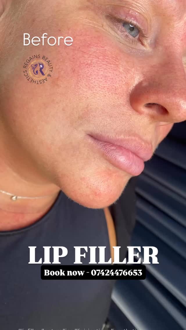 Soft volume. Natural shape. Still you 💉🤍
The “no one knows, but everyone notices” lips.
DM 07424476653
Location - Milton Keynes
#lipfiller #naturallips #lipinjections #aesthetics
#beauty glowup selfcare confidence fyp explorepage
reels trending instabeauty cosmeticinjectables