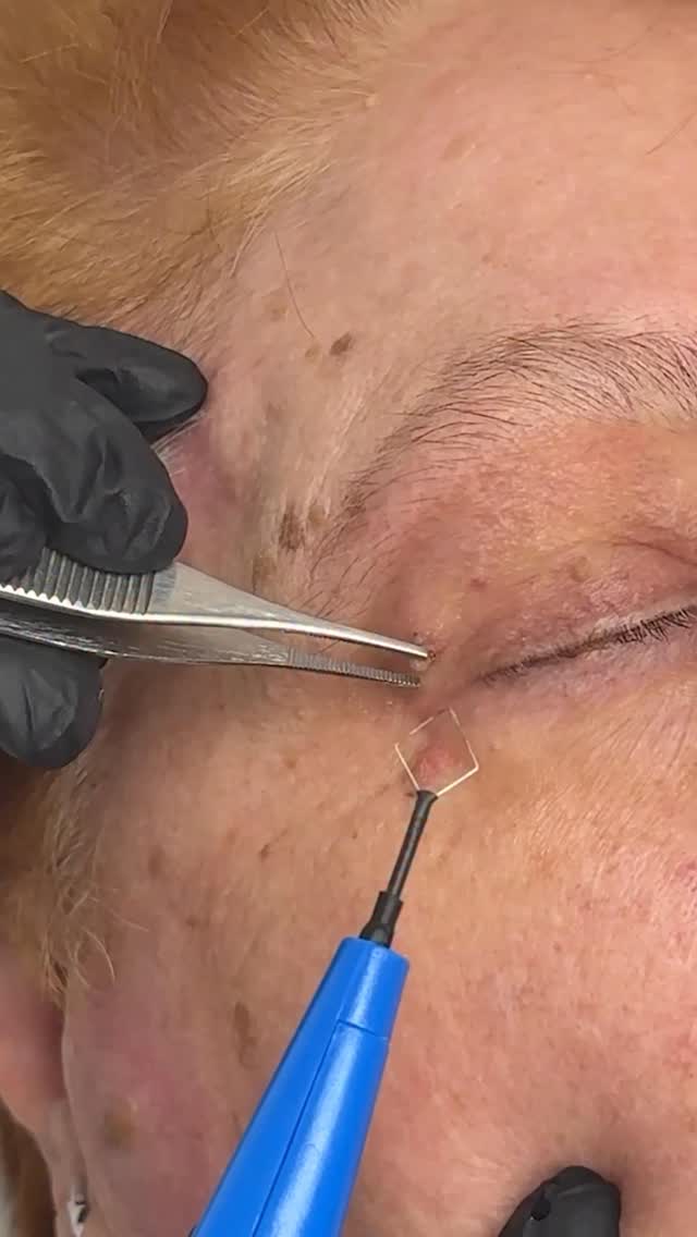 ¿Tenés “verruguitas” en cuello, axilas o párpados?
¡Los acrocordones tienen solución! ✨
Los removemos con electrobisturí:
⚡ simple
⚡ rápido
⚡ prácticamente sin downtime
En pocos minutos podés mejorar la apariencia de tu piel 🙌
📲 Consultorio: 1166662866
#Acrocordones #Dermatologia #PielSana #MedicinaEstetica #SkinCare Dermatologo Laser EsteticaFacial BuenosAires SkinQuality