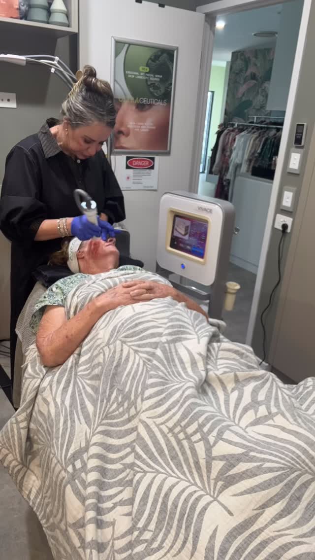 ✨ Tighten • Strengthen • Rejuvenate ✨
If you’re noticing skin laxity, loss of firmness or that your skin just isn’t feeling as strong and youthful as it once did… our Radiofrequency Needling treatment could be exactly what your skin has been waiting for 💫
This advanced treatment works deep within the skin to stimulate collagen and elastin, helping to tighten, strengthen and restore a firmer, smoother appearance over time.
Your appointment takes approximately 1 hour and 20 minutes, including topical anaesthetic for comfort. Downtime is minimal — most clients simply experience some warmth, redness and mild tenderness for around 24 hours ❤️
Perfect for:
✨ Skin tightening
✨ Jawline definition
✨ Crepey skin
✨ Fine lines & wrinkles
✨ Strengthening thinning skin
✨ Overall rejuvenation & glow
If you’ve been feeling concerned about skin laxity, this treatment can be such a beautiful confidence boost 🙌
📞 Call or SMS 0416 999 227 to book your consultation and let’s create a treatment plan tailored just for you.
We can’t wait to look after your skin 💚
#AboutFacesNoosa #NoosaSkinClinic #RFSkinNeedling #RadiofrequencyNeedling #SkinTightening CollagenBoosting SkinRejuvenation NoosaBeauty LuxurySkinClinic AntiAgeingTreatment SkinStrengthening CollagenInduction HealthySkin NoosaAesthetics FirmingTreatment GlowingSkin SkinConfidence RFNeedling BeautifulSkinStartsHere NoosaWaters NoosaLife AgeGracefully SkinGoals AdvancedSkinTreatments Cutera SkinClinicAustralia YouthfulSkin FineLines WrinkleReduction LaxityTreatment