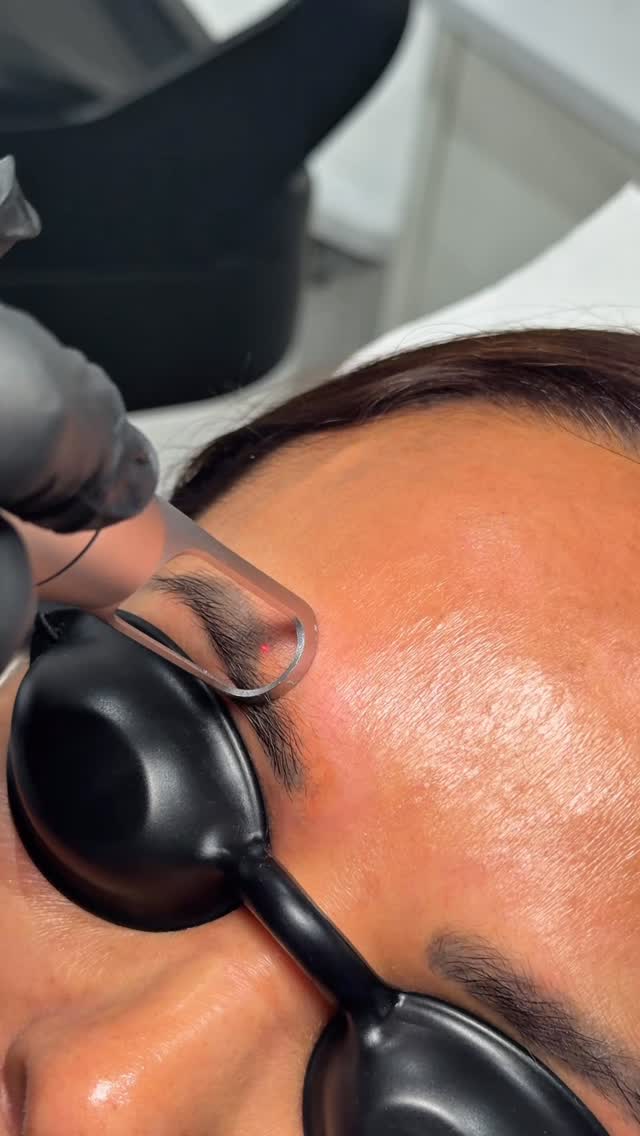 Watch the pigment lift in real time ✨
This is the immediate response during laser eyebrow tattoo removal notice how the ink begins to break down and lighten as the laser targets the pigment beneath the skin.
If you’re ready for a fresh start or a softer, more natural look, we’re here to guide you every step of the way 🤍
