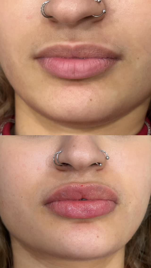 We decided on 0.7ml to keep everything soft, balanced, and super natural. Clients goal was a subtle enhancement with a little more plumpness, definition, and improved symmetry — while still looking completely like herself.
The most beautiful results are the ones that enhance, not overpower!
#lip #lipfillerjourney #filler #london #before
