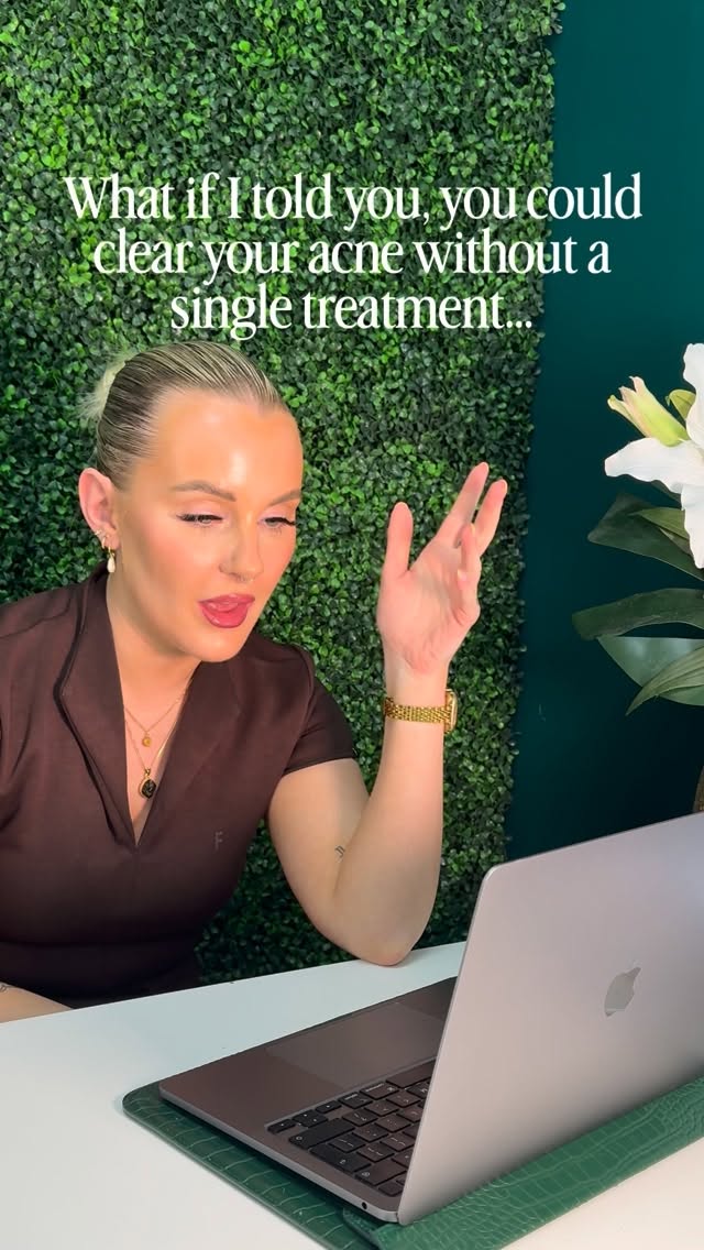 What if I told you your acne could start clearing without you even stepping foot into a clinic? 👀✨
Because despite what social media tells you, acne is rarely just about what’s happening on the surface.
You can have every facial, peel and LED session under the sun. But if your hormones are imbalanced, your nervous system is dysregulated, your gut is struggling, your barrier is damaged, you’re sleeping 5 hours a night and living off cortisol and caffeine… your skin will keep trying to tell you something babe 👀
This is exactly why so many people feel stuck in a cycle of:
• temporary results
• constant flare ups
• wasting money on products
• feeling like “nothing works”
Real acne clearing comes from understanding the full picture. Internal support. Correct skincare. Consistency. Education. A proper plan 🫶🏼
Treatments absolutely have their place, but your skin will only thrive long term when you support it from the inside too 🤍
And very soon, I’m going to be showing you exactly what that can look like 👀
01.06.26 ✨
If you’re tired of guessing and ready to actually understand your skin, DM me the word “ACNE” and I’ll send you my new FREE acne e-book 📖⚡️