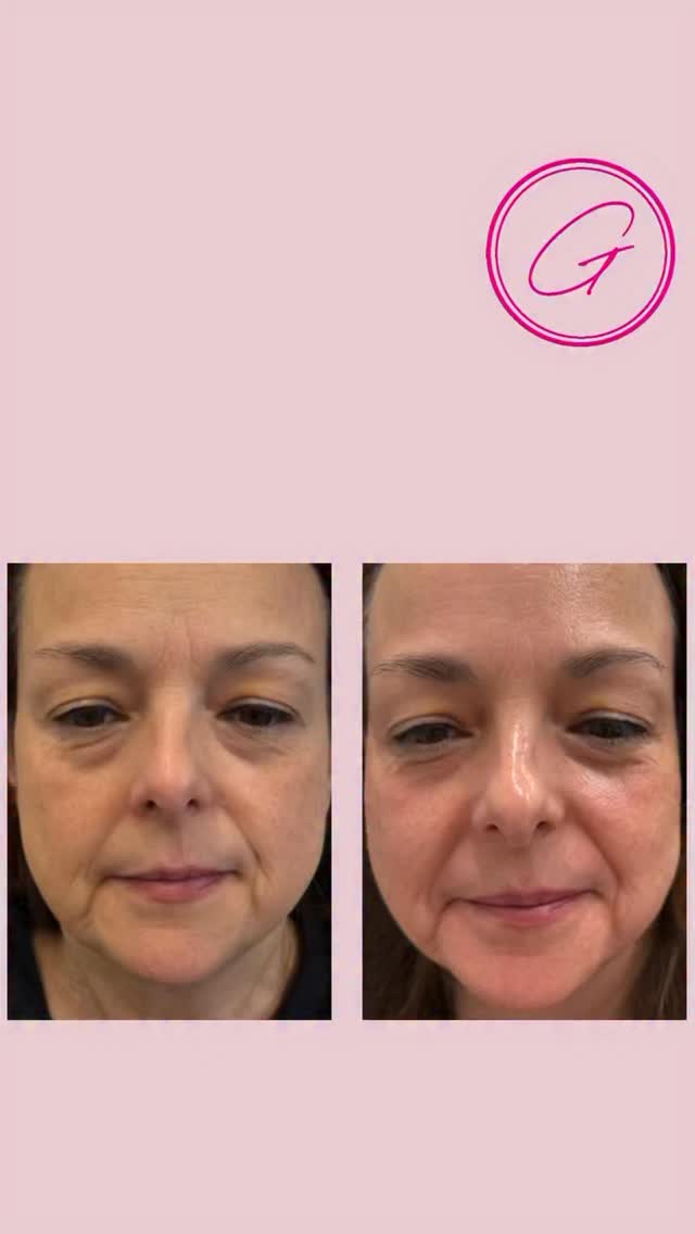 Oxygen Facial + (Added Peel) = next-level glow ✨
This treatment combines deep oxygen infusion with a customized chemical peel for results you can see immediately.
We start with a double cleanse, followed by our signature Oxygen Bomb Whipping Mask infused under 92% oxygen + anion therapy to energize and prep the skin.
Then we layer in the magic:
✨ A tailored chemical peel (2 layers) based on your skin goals—perfect for brightening, smoothing texture, and evening tone.
Next, we infuse hyaluronic acid + vitamin oxygen for that fresh, cool plunge feeling—hydration meets oxygenation.
You’ll finish under the oxygen dome with LED light therapy (green for pigmentation, yellow for healing) to calm, restore, and amplify your glow.
💡 Why add the peel? It boosts cell turnover, allowing oxygen + active ingredients to penetrate deeper—aka smoother, brighter, glassier skin.
Perfect before events, big moments, or anytime your skin needs a reset.
Glow harder, not longer 💫#skinrejuvenation #oakvillemedspa #burlingtonmoms #supportlocal #glassskin