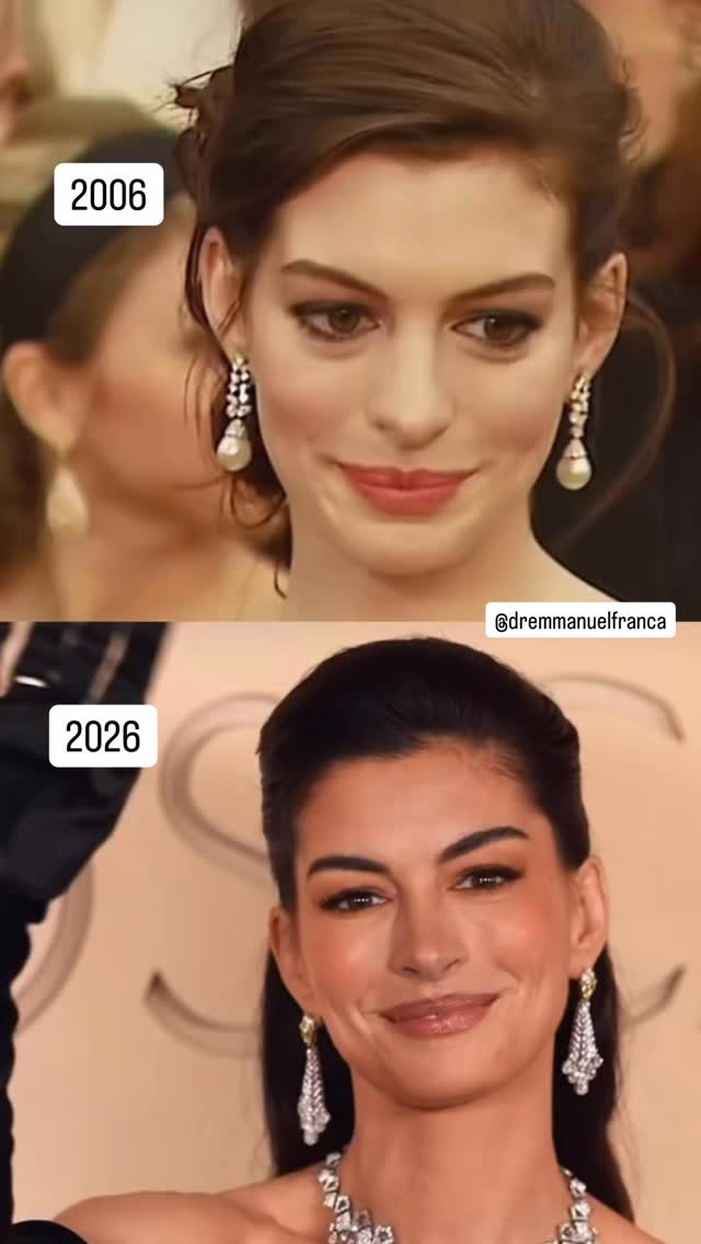 De 2006 para 2026, muita coisa mudou, mas uma delas chama atenção: a forma como Anne Hathaway envelheceu de maneira equilibrada e natural.
O que vemos não é ausência de envelhecimento, e sim um bom gerenciamento dele. Pele com qualidade, traços preservados, naturalidade nas expressões e harmonia facial mostram como a dermatologia moderna evoluiu.
Hoje, envelhecer bem passa por estratégias como estímulo de colágeno, tecnologias, proteção solar, skincare e procedimentos realizados com critério e individualização.
Por isso, um bom gerenciamento é acompanhar as mudanças da pele sem perder identidade.
Dr Emmanuel França
Dermatologista
CRM 5999
RQE 636