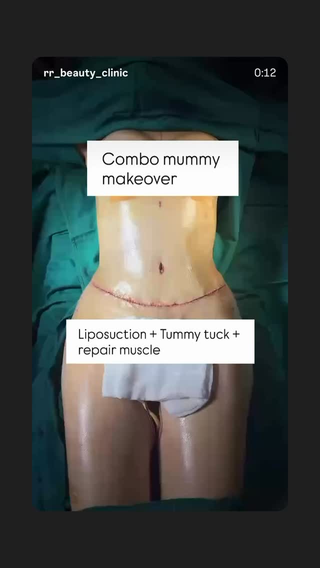 Vietnam Medical Tourism
Combo mummy makeover
#medicaltourism #fatremoval #lipo360 #lipo #tummytuck
