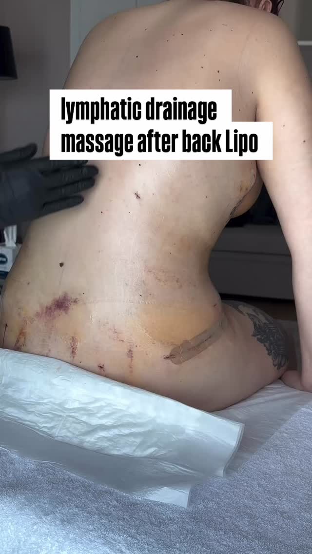 After liposuction, regular lymphatic drainage massage is recommended, about 2–3 times per week.
Post-operative care is very important as it helps reduce swelling, prevent fluid retention, and ensure a smooth, even, and optimal healing result.
Warning signs to watch for:
If fluid accumulation occurs, the abdomen may not appear flat and can look swollen, bloated, or uneven. If not treated promptly, this condition may increase the risk of infection and affect the final aesthetic outcome.
#medicaltourism #fatremoval #lipo360