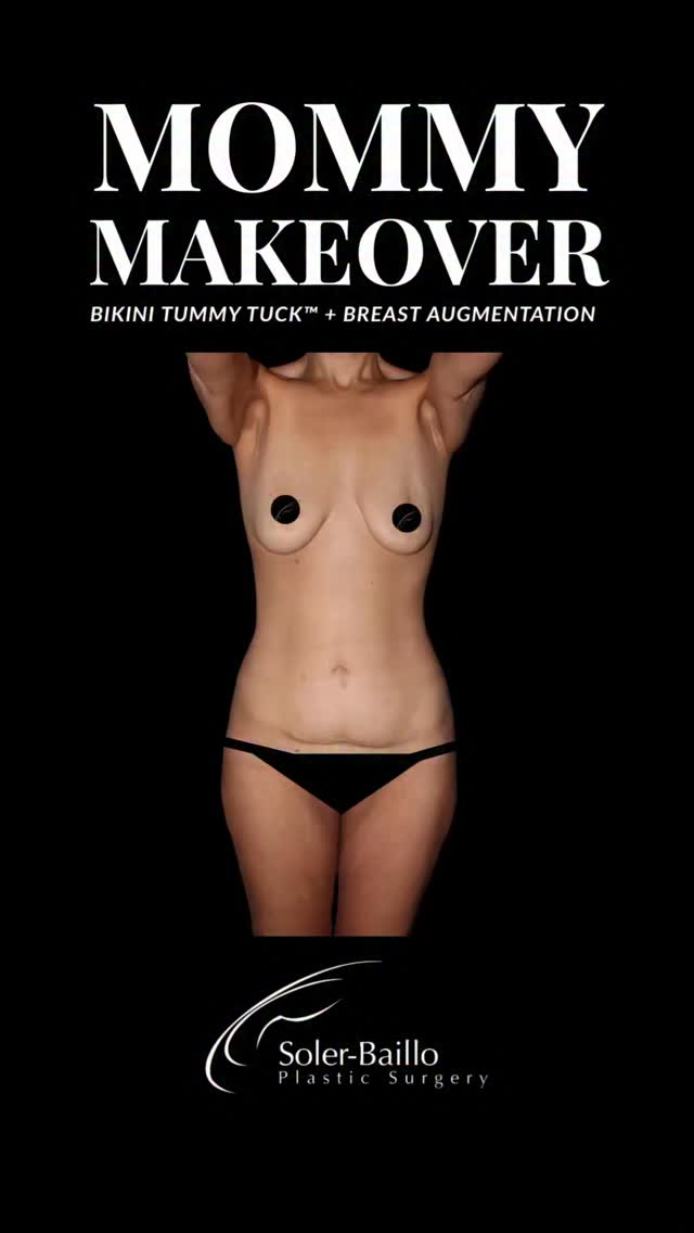 💫 A “Mommy Makeover” is commonly used to describe the combination of a tummy tuck and breast augmentation, but this transformative procedure is not just for post-pregnancy patients. It can also be an incredible option after major weight loss to restore balance, shape, and confidence.
This patient is 3 months post-op after Dr. Soler-Baillo’s signature Bikini Tummy Tuck™, a low-scar abdominoplasty designed to create a sleek, sculpted waistline with his Beautiful Bella Button™, paired with a breast augmentation to restore soft, feminine volume. 💕
📩 Ready to learn what combination procedure may be right for you? Schedule your consultation today.
#MommyMakeover #TummyTuck #BreastAugmentation #WeightlossTransformation #BodyContouring