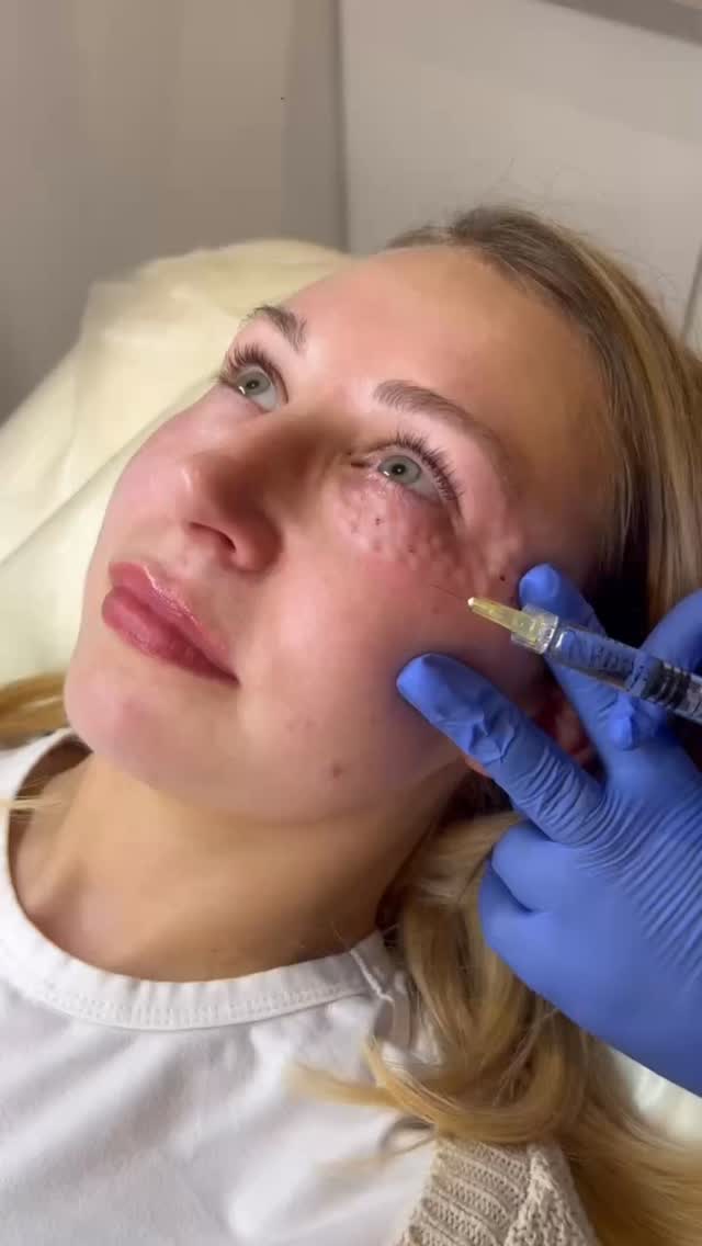 Tired-looking under eyes? Polynucleotides could be the skin refresh you’ve been looking for.
Polynucleotides are one of the most effective treatments for improving the delicate under-eye area naturally.
By stimulating collagen, boosting hydration, and supporting skin repair, this treatment can help to:
• Soften fine lines and crepey skin
• Improve dark circles
• Hydrate tired under eyes
• Brighten and refresh the eye area
• Improve overall skin quality naturally
The result is fresher, healthier-looking under eyes without adding volume or looking overdone.
At Elite Nurse Led Aesthetics in Wakefield, all treatments are tailored to achieve subtle, natural-looking rejuvenation.
Ready to refresh tired under eyes?
DM now to book your consultation or appointment.
#EliteAesthetics #WakefieldAesthetics #Polynucleotides #UnderEyeRejuvenation #SkinBoostingTreatment