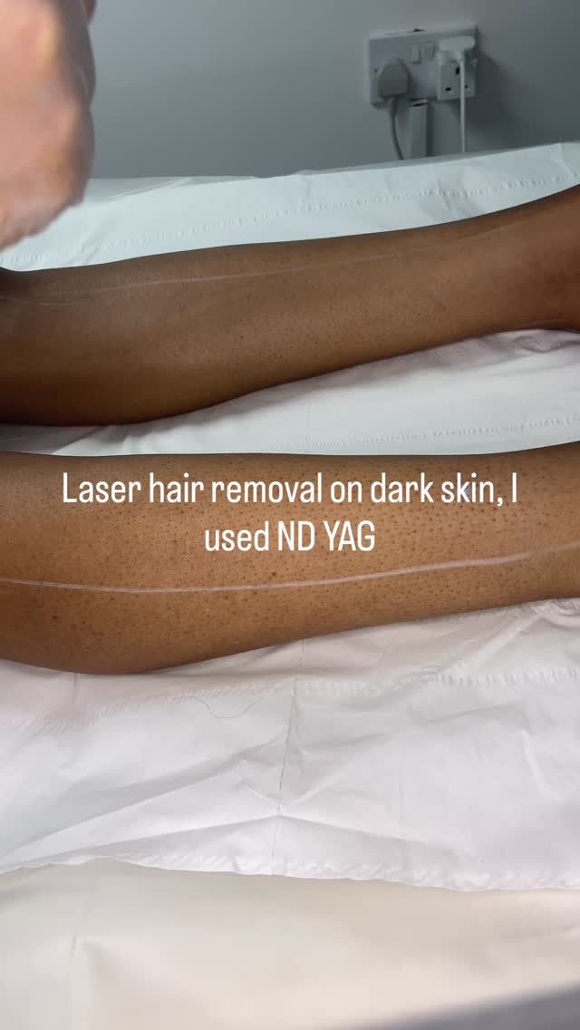 Nd:YAG laser hair removal uses a deep-penetrating 1064nm wavelength to target hair follicles. It is widely regarded as the safest and most effective laser technology for darker skin tones and tanned skin because it bypasses surface melanin to prevent burns and hyperpigmentation.
Safety: Minimizes the risk of epidermal damage, scarring, or pigmentation changes.
Efficiency: Best suited for dark, coarse hairs; it is less effective on very fine, light-colour.
#ndyaglaser #kentbusiness #darkskinlaser#laser #