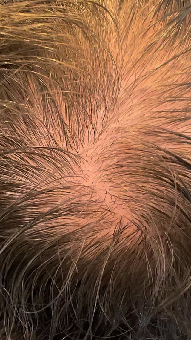Another PRP hair rejuvenation journey ✨
12 months on and staying the course 🤍
This client completed:
✨ 3 initial PRP sessions
✨ 6-monthly maintenance treatments
The result?
Healthier-looking hair with improved thickness, length and overall rejuvenation over time.
One of the most important things to remember with PRP is that results are gradual. Hair restoration takes patience, consistency and perseverance — but the long-term improvements can be so rewarding ✨
PRP can be a brilliant option for those experiencing miniaturised hair follicles, where hairs become thinner, weaker and less healthy over time.
Starting early is key 🔑
Supporting the follicles before significant loss occurs often leads to the best outcomes.
Trust the process. Stay consistent. See the results 🤍
#PRPHairTreatment #HairRejuvenation #HairRestoration #PRPTherapy #NaturalAesthetics