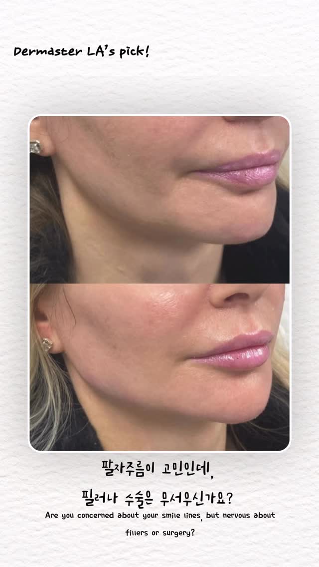 Radiesse
Natural volume that lasts β¨
β¨Radiesse is more than just a filler,
it helps stimulate collagen production while restoring volume from within.
You get immediate improvement, with results that continue to look more natural over time.
It works especially well for smile lines, hollow cheeks, and jawline definition anywhere volume loss is a concern.
The key point is natural-looking results that blend with your own skin.
μμ°μ€λ½κ² μ±μ°κ³ , μ€λ μ μ§λλ λ³Όλ₯¨ β¨β¨
λ λμ΄μ€λ λ¨μν νλ¬κ° μλλΌβ¨μ½λΌκ²
μμ±μ μ λνλ©΄μ νΌλΆ μλΆν° νλ ₯μ μ±μμ£Όλ μμ μ
λλ€.
μ¦κ°μ μΈ λ³Όλ₯¨ κ°μ + μκ°μ΄ μ§λ μλ‘
μμ°μ€λ¬μμ§λ νΌλΆ λ³νβ¨νμμ£Όλ¦,
κΊΌμ§ λ³Ό, ν± λΌμΈμ²λΌβ¨βκΊΌμ§βμ΄ κ³ λ―ΌμΈ
λΆμμ νΉν ν¨κ³Όμ μ΄μμ.
λΆμμ°μ€λ¬μ΄ λλ μμ΄β¨λ³ΈμΈ νΌλΆμ²λΌ μμ°μ€λ½κ² κ°μ λλ κ² ν¬μΈνΈμ
λλ€.
π 3000 W Olympic BlvdΒ #305, Los Angeles
π 213-814-8410
#λ λμ΄μ€ #Radiesse #μ½λΌκ²λΆμ€ν° #νλ¬ #μ€ν¨λΆμ€ν° #νμμ£Όλ¦ #νλ ₯κ°μ #λ³Όλ₯¨κ°μ #νΌλΆκ³Όμμ #Kbeauty #SkinClinic #AestheticMedicine #DermalFiller #CollagenStimulator #GlowSkin #SkinRejuvenation #AntiAging #DermatologyClinic