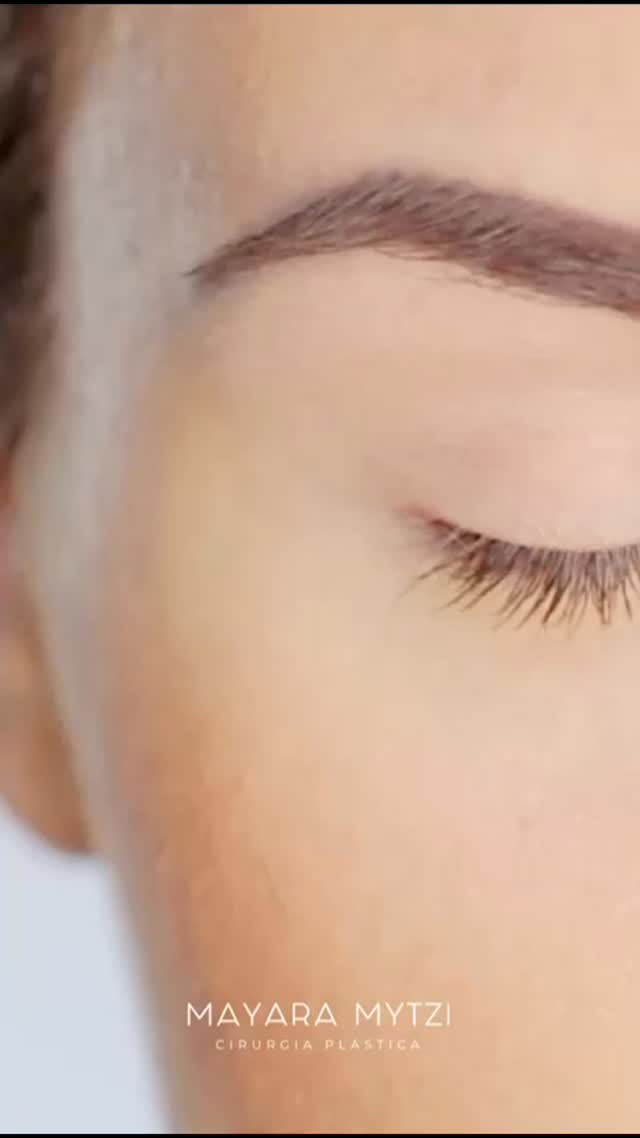O segredo de um olhar bonito pode estar um pouco acima dos olhos.
O supercílio é a moldura do olhar e, quando bem posicionado, traz mais leveza e harmonia ao rosto.
Com o tempo ou pela anatomia, pode ficar mais baixo e dar um aspecto cansado.
Existem diferentes formas de tratar, como toxina botulínica, preenchimento ou cirurgia. E a escolha depende da posição do supercílio, da anatomia periorbitária e da avaliação da pele da região.
Nas cirurgias, há opções que podem ser realizadas no consultório e também procedimentos realizados em hospital por videocirurgia. Quer saber qual o melhor para você? Eu lhe aguardo para a nossa primeira consulta!
Dra. Mayara Mytzi
CRM SP 136.044 • Médica
Cirurgiã Plástica • RQE 66881