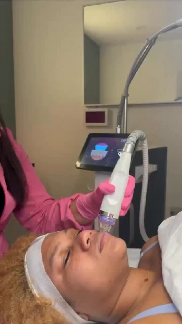 The secret is science.
Secret RF combines radiofrequency (RF) energy + microneedling to stimulate controlled dermal injury and activate the skin’s natural repair mechanisms.
At a biological level, the micro-injuries trigger a wound healing cascade, increasing fibroblast activity and promoting the synthesis of collagen type I and III, as well as elastin.
Simultaneously, RF energy delivers thermal stimulation at precise dermal depths, enhancing neocollagenesis, improving skin density, and remodeling tissue without damaging the epidermis.
Result: improved texture, reduced fine lines, minimized pores, and firmer, more structured skin over time.
This is not surface-level skincare — it’s dermal remodeling driven by controlled energy delivery.
#secretrf #MicroneedlingRF #SkinScience #nycmedspa