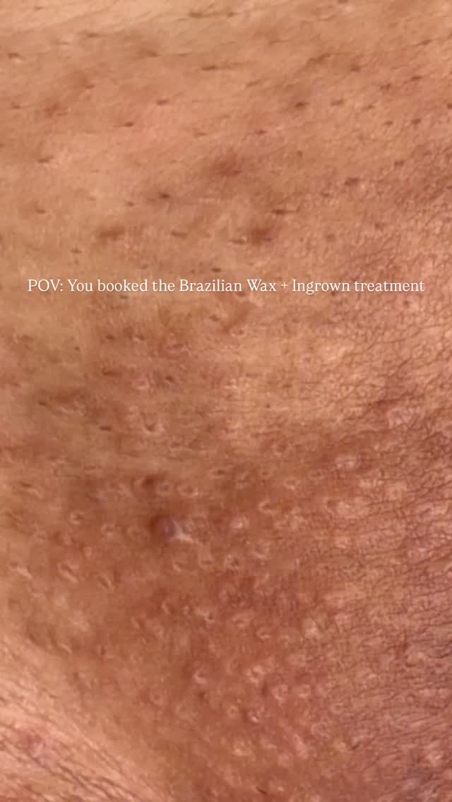 This treatment focuses on smoother results, healthier skin, and treating stubborn ingrowns + congestion between appointments ✨
Step 1: Cleanse + prep the skin
Step 2: Gentle Brazilian wax using hard wax
Step 3: Controlled steam or steam towel to soften the skin
Step 4: Apply a pre-extraction solution to soften congestion + prep the skin
Step 5: Careful ingrown extractions
Step 6: High frequency treatment if needed
Step 7: Finish with an ingrown treatment paste to exfoliate, calm inflammation, and help prevent future ingrowns
#atlantaesthetician #brazilianwaxatlanta #ingrowntreatment #atlantawaxing #ingrownhairtreatment
