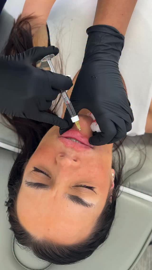 Wedding prep in full swing… glowing skin, fresh lips, and every little detail perfected for the big day 💍🤍
Do you have a wedding or event coming up you want to feel your best but don’t know where to start or when to have treatments done?
Book in a consultation and we can schedule everything to make sure everything is settled and perfect in time for your big day ✨