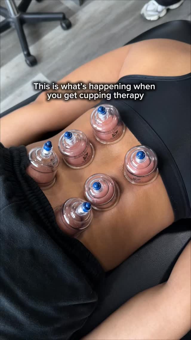 Tired of sore muscles slowing you down? It’s time to try Cupping.
Cupping is a therapy that uses suction to break up adhesions, boost circulation and get your body feeling like new.
Here’s how cupping can benefit you:
→Enhances your Range of Motion
By releasing the fascia, cupping restores the natural glide between muscle layers, so you move with more freedom and less restriction.
→Relives Muscle Tension
The suction lifts deep tissue layers, targeting stubborn knots that stretching and foam rolling just can’t reach.
→Accelerates Muscle Recovery
By flooding the area with fresh, oxygenated blood, cupping helps your muscles bounce back faster after intense training.
→Calms the Nervous System
Cupping activates the parasympathetic nervous system, helping your body shift out of stress mode and into full recovery mode.
→Targets Chronic Pain at the Source
Whether it’s your neck, back, or hips — cupping works directly on the affected area to provide lasting relief, not just temporary comfort.
Your recovery deserves more than ice and rest. Cupping works with your body to keep you moving at your best!
📍Pickering, ON
Visit the link in our bio @seaton.physio or call us at (905)-427-0505 to book! Your appointment today!
#cuppingtherapy #cuppingmassage #cupping #sportstherapy #massagetherapists
