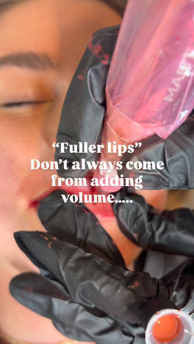 Lip blush restores shape, balances tone and creates the illusion of fullness without changing your natural lips.
My personal preference?
Lip blush first, then subtle filler later if you still want extra volume ✨