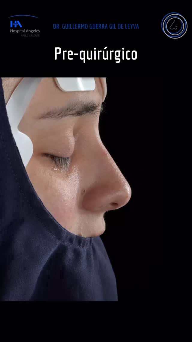 🔹 Tu satisfacción es nuestra prioridad. Cada Rinoplastia es diseñada para ti, considerando tus facciones y deseos.
🔹Evolución a un mes de Cirugía Nasal Estética y Funcional.
🔹 Gracias a mi excelente paciente por su confianza y permitir compartir su resultado.
🔹”Made by hand. Crafted with passion”
🧑⚕️ Dr. Guillermo Guerra Gil de Leyva
🏥 Hospital Ángeles Valle Oriente
📱 81-1252-0132
🎓Universidad de Monterrey
👃 Rinoplastia Estética y Funcional
🚫 No taponamiento
Cédula Profesional: 3070499
Cédula Especialista: 4503273
No. Certificación CONACEM: GUG-1748/04
Aviso de Publicidad COFEPRIS: 2419032002A00111
❕Paciente autoriza difusión de imágenes con fines académicos e informativos.
❕Los resultados finales se pudieran observar hasta un año de la cirugía y dependerá tanto del compromiso del cirujano como del paciente, así como del tipo de cirugía, tipo de piel, cuidados post-operatorios, etc.
#RinoplastiaPersonalizada #TuNarizTuEstilo
#rinoplastia #rhinoplasty #nosejob septoplasty rinoseptumplastia rhinoseptoplasty nosejob nose nosesurgery tabiquenasal otorrinolaringologia entsurgery cirugianasal cirugiatabique cirugiaesteticanasal
belleza confianza autoestima
cosmeticsurgery
otorrinolaringologiamonterrey otorrinomonterrey beforeandafter antesydespues
estructuredrhinoplasty
rinoplastiaestructurada
rinoplastiaultrasonica
ultrasonicrhinoplasty