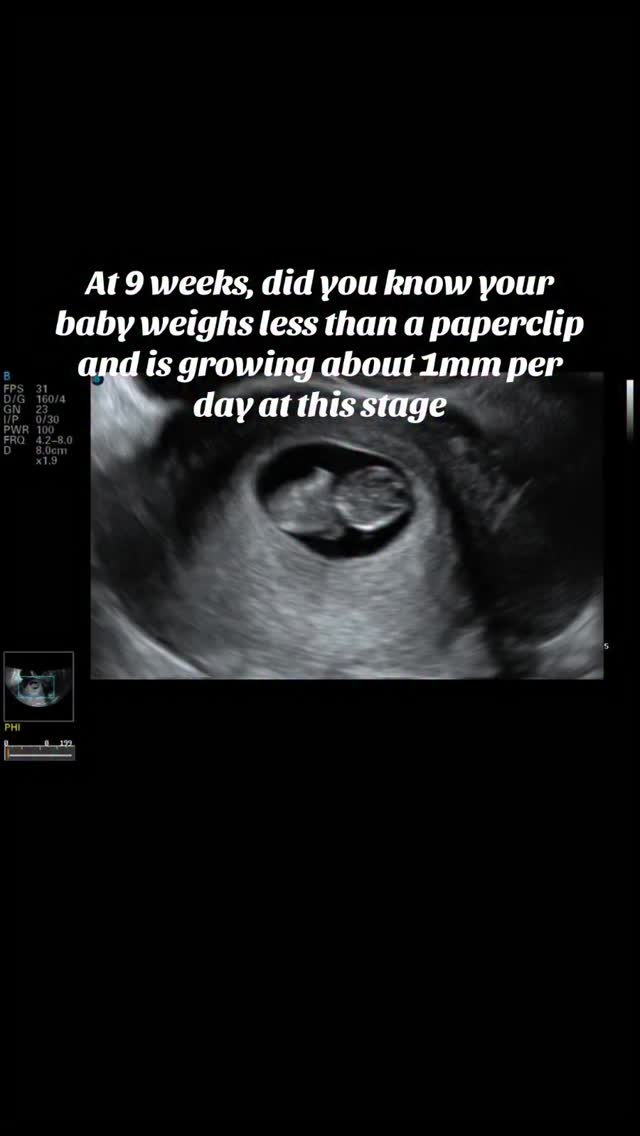 At 9 weeks
•All essential organs have formed and are starting to function
•The heart has 4 chambers and beats 150–170 times per minute — nearly twice an adult’s rate
•Tiny earlobes, fingers, and toes are visible, and the webbing between fingers is disappearing
•Eyes are fully formed but fused shut
Ready to see your baby ? Book a mini session today at Sweetpea3d4dultrasound.com
#3d4dultrasound #momtobe #9weekspregnant