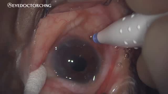 This is a case of a spontaneous dislocated intraocular lens and a history of idiopathic uveitis. This video highlights the steps taken to remove the IOL and replaced it with a new IOL using the Yamane scleral fixated haptic technique. A Kowa preloaded 3 piece Avansee IOL with PVDF (polyvinylidene fluoride) haptics was used in this case. PVDF haptics are preferred because they are flexible, durable and can be cauterized to form a secure flange without easily kinking or breaking.
#dislocatediol #eyesurgery #vitrectomysurgery #ophthalmology #eyedoctorchng