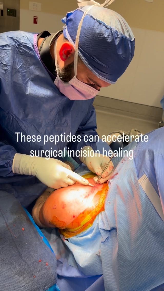 Struggling with slow incision healing or worried about scarring after surgery?
There are powerful peptides that can dramatically support your recovery by:
✨ Boosting collagen production for stronger, more organized tissue repair
🔥 Significantly reducing inflammation to speed up the healing process
🛠️ Improving overall wound closure and skin regeneration
The result? Faster recovery, better cosmetic outcomes, and less scar tissue.
If you want the full list of peptides we recommend for post-surgical healing, DM us or comment “ALPHA” below and we’ll send it straight to you!
#SurgicalRecovery #biohacking #AlphaPerformanceClinic #surgery #healing