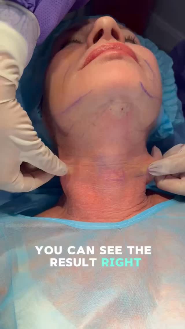 That immediate tightening effect?
It’s thermal retraction ✨
Endolaser contracts the skin from the inside out while triggering collagen production for the next few months 🤍
Minimal discomfort, performed by a licensed professional @gilenablg APRN 🪄
Instant snatch now… collagen glow later 🤍
No big surgery. Minimal downtime. Natural reshaping.
#Endolift #Endolaser #SkinTightening #CollagenBoost