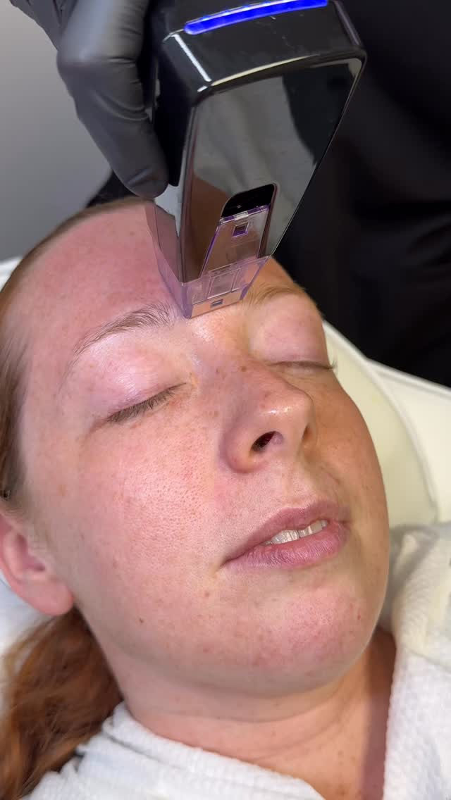 Hyperpigmentation. Hollowing. Dark circles. Crepey under-eyes.
These concerns are rarely caused by just one issue — which is why treatment should never be one-dimensional.
At Elevate by Emilie Eve, we combined the power of Elevate Genesis with Regen collagen restoration under the eyes to target multiple layers of concern at once. ✨
Elevate Genesis works to improve skin tone, texture, discoloration, and overall skin quality by stimulating collagen and resurfacing damaged tissue, while Regen helps restore support beneath the eyes to soften hollowing and create a brighter, more refreshed appearance naturally over time.
The goal is not to make you look “done.”
The goal is to make you look healthier, rested, and like yourself again.
This area requires precision, anatomy knowledge, and an artistic approach — because under-eyes can either be beautifully refreshed… or very quickly overtreated.
Natural restoration will always be the standard here. 🤍
#ElevateByEmilie #UnderEyeTreatment #Hyperpigmentation #RegenCollagen #UnderEyeRejuvenation