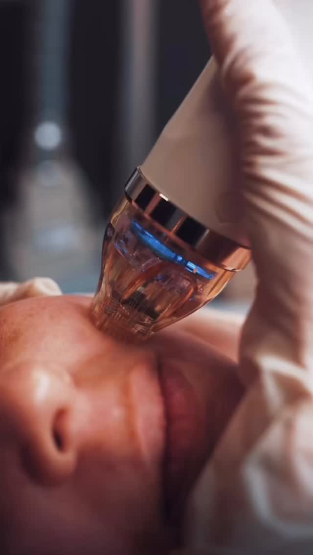 SOMETHING BIG IS COMING TO ABOUT FACES NOOSA
Introducing the NEW Cutera Secret PRO® — the next generation in skin rejuvenation.
This powerhouse device combines Radio Frequency Microneedling + fractional CO2 technology for incredible skin transformation results.
Think:
✨ Acne & acne scarring
✨ Fine lines & wrinkles
✨ Skin tightening
✨ Collagen induction
✨ Texture refinement
✨ Pigmentation support
✨ Overall skin rejuvenation
This is advanced skin technology designed to help your skin look smoother, firmer, fresher and more radiant.
And trust us… this is only the beginning. 🤍
COMING SOON TO ABOUT FACES NOOSA.
#AboutFacesNoosa #SecretPRO #CuteraSecretPRO #RFMicroneedling #CO2Laser NoosaSkinClinic LuxurySkinClinic CollagenInduction AcneScarringTreatment SkinRejuvenation Microneedling AntiAgeingTreatment NoosaBeauty LaserSkinTreatment GlowingSkin SkinTightening AdvancedSkinTreatments NoosaBusiness DermalTherapy AgeingGracefully