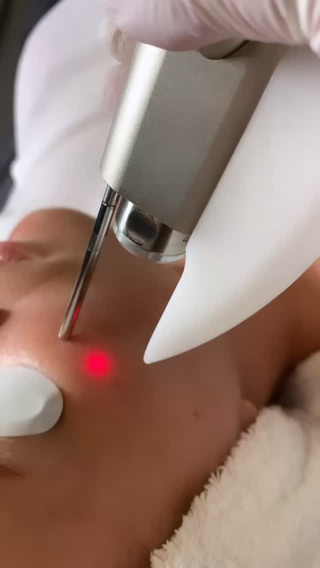 ✨ Rødhet i huden? Synlige blodkar? Ujevn og sensitiv hud? Svak hudbarriere? Rosacea, akne eller annen betennelse i huden?
Nd:YAG-laser (Fotona SP Dynamis) jobber dypt i huden og reduserer rødhet på en trygg og skånsom måte – uten å skade hudoverflaten.
💡 Vår helårsfavoritt Redness Reset er en behandling som passer de fleste hudtyper – og kan gjøres trygt hele året, når det utføres riktig. Den er super å kombinere med reduksjon av synlige blodkar i ansiktet, og ved Skinsation velger vi ofte å oppgradere behandlingen med Photobooster 119 for å roe ned huden, styrke barrieren og gi best mulig resultat.
🌿 Bonusen mange ikke forventer:
jevnere hudtone, mer glød og en hud som føles roligere og mer balansert over tid.
✨ Ikke bare skjul rødheten med sminke – jobb målrettet med å redusere symptomene og årsaken som forårsaker rødheten. Sannheten er at veldig mange går rundt med en svekket hudbarriere og betennelsestilstander i overhuden, og vi har mange gode knep for å adressere dette ♥️🆘
Husk å investere i behandlinger der du blir tilbudt kompetanse og erfaring. Vi har hatt Fotonalaser i over 5 år, bruker den daglig i vår virksomhet - og tar kurs i både inn og utland for å sikre deg en trygg og målrettet behandling som vil sikre deg gode resultater 🦋