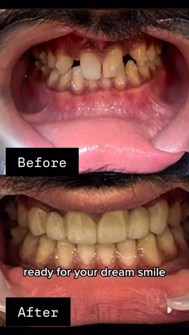 Get your dream smile today at Prive Aesthetics✨
Book your appointment now