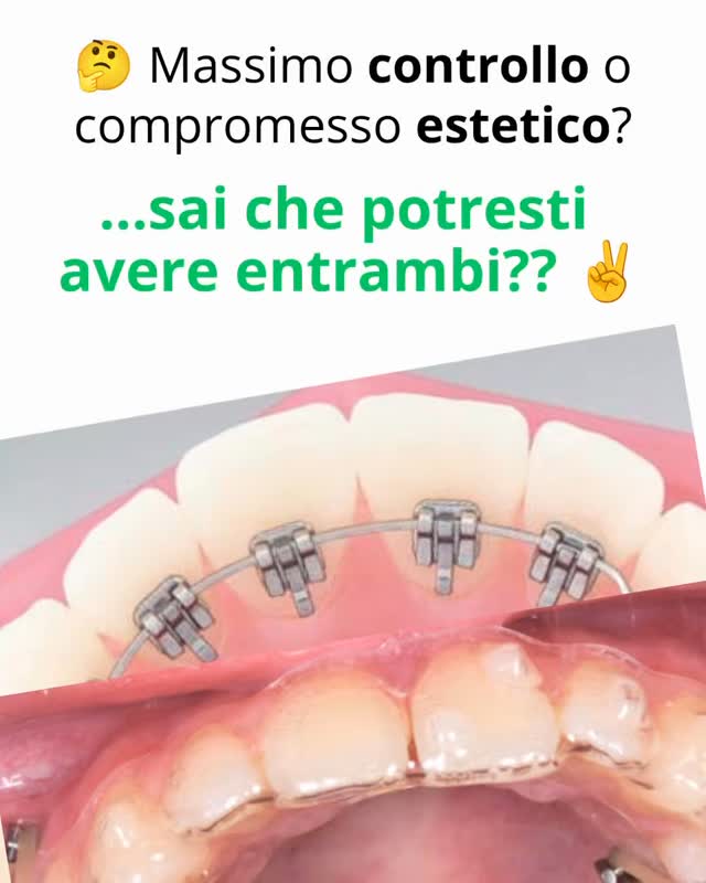 Nuovo Corso Formativo
Allineatori e Ortodonzia Linguale 2D
L’ortodonzia Invisibile Evoluta
👨⚕️Dr. Vittorio Cacciafesta
📍MILANO
📆 24 ottibre 2026
👉Iscrizioni aperte
www.orthopiu.it/corsi
#ortodonzia #ortodonziainvisibile #ortodonzialinguale