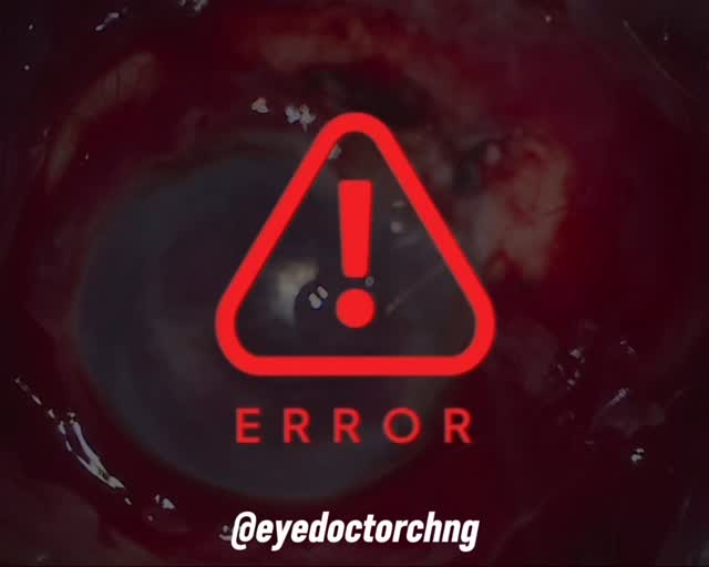 Helping out our senior vitreoretinal VR fellow @dspy8 repair a scleral rupture following a blunt trauma.
An extra pair of hands to help dry the wound, appose tissues and expose the surgical plane always help these type of surgeries to be completed in an efficient and safe manner thus leading to a better outcome for the patients.
#oculartrauma #eyesurgery #ophthalmology #eyetrauma #eyedoctorchng