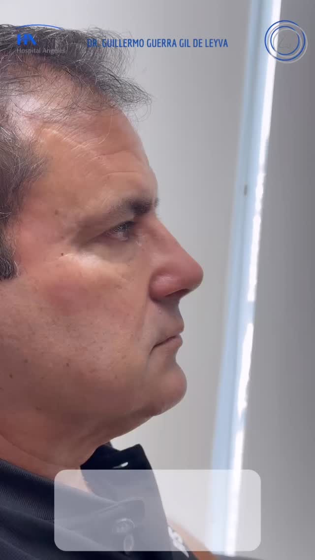 🔹 La Rinoplastia Personalizada se adapta a tu rostro, tus rasgos y tus expectativas. Natural, armónica y única.
🔹Evolución a un mes de Cirugía Nasal Estética y Funcional.
🔹 Gracias a mi excelente paciente por su confianza y permitir compartir su resultado.
🔹”Made by hand. Crafted with passion”
🧑⚕️ Dr. Guillermo Guerra Gil de Leyva
🏥 Hospital Ángeles Valle Oriente
📱 81-1252-0132
🎓Universidad de Monterrey
👃 Rinoplastia Estética y Funcional
🚫 No taponamiento
Cédula Profesional: 3070499
Cédula Especialista: 4503273
No. Certificación CONACEM: GUG-1748/04
Aviso de Publicidad COFEPRIS: 2419032002A00111
❕Paciente autoriza difusión de imágenes con fines académicos e informativos.
❕Los resultados finales se pudieran observar hasta un año de la cirugía y dependerá tanto del compromiso del cirujano como del paciente, así como del tipo de cirugía, tipo de piel, cuidados post-operatorios, etc.
#RinoplastiaPersonalizada #TuNarizTuEstilo
#rinoplastia #rhinoplasty #septoplastia septoplasty rinoseptumplastia rhinoseptoplasty nosejob nose nosesurgery tabiquenasal otorrinolaringologia entsurgery cirugianasal cirugiatabique cirugiaesteticanasal
belleza confianza autoestima
cosmeticsurgery
otorrinolaringologiamonterrey otorrinomonterrey beforeandafter antesydespues
estructuredrhinoplasty
rinoplastiaestructurada
rinoplastiaultrasonica
ultrasonicrhinoplasty