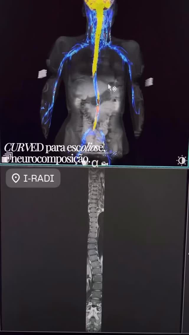 A ressonância magnética oferece um nível único de conhecimento, mas os exames de imagem devem sempre estar alinhados com a questão clínica.
Na maioria dos casos, os sintomas guiam a investigação direcionada. Neste caso, o paciente foi encaminhado para avaliação da coluna com queixa de dor e suspeita de desvio postural.
A ressonância magnética com protocolo dedicado incluindo curva de escoliose e neurocomposição permitiu avaliar com precisão o grau da curvatura, a integridade das estruturas neurais e os segmentos comprometidos, oferecendo ao médico informações detalhadas para uma conduta mais assertiva.
Isso reforça a importância tanto da imagem avançada quanto da comunicação clínica clara: quanto mais precisa a indicação, mais preciso o protocolo e melhores os resultados para o paciente.
#iradi #institutoderadiologiadetoledo #radiologia #toledo #ressenanciamegnetica