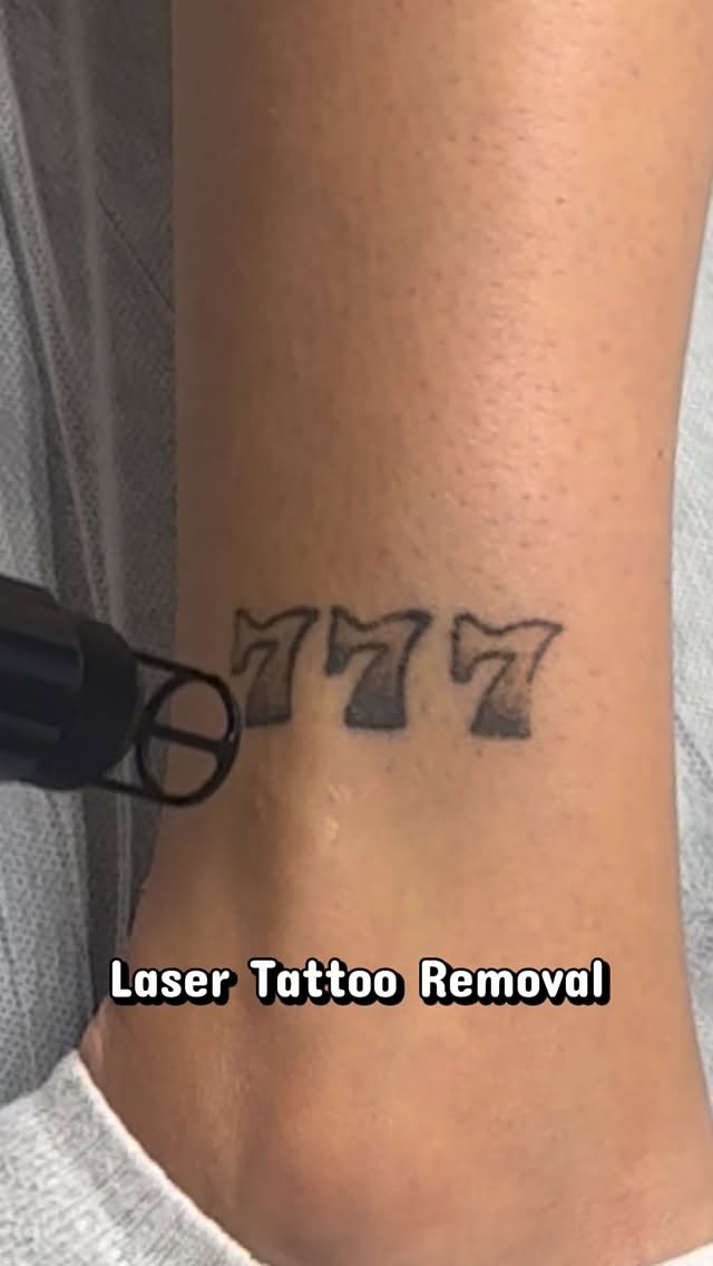 The instant satisfaction I get when doing laser tattoo removal ⚡️
Have a tattoo you no longer like come see me.
Prices start at $100 and go up from there depending on the piece. All information can be found on my website.
www.satiskinspa.com
Let me remove what no longer resignates with you.
#laser #lasertattooremoval #tattooremoval #lasvegas #Iv