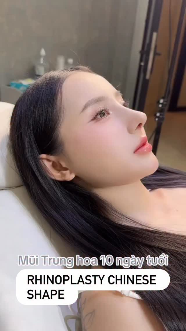 Rhinoplasty Chinese style after removal stich
#rhinoplasty #rhinoplastybeforeandafter #rhinoplasty