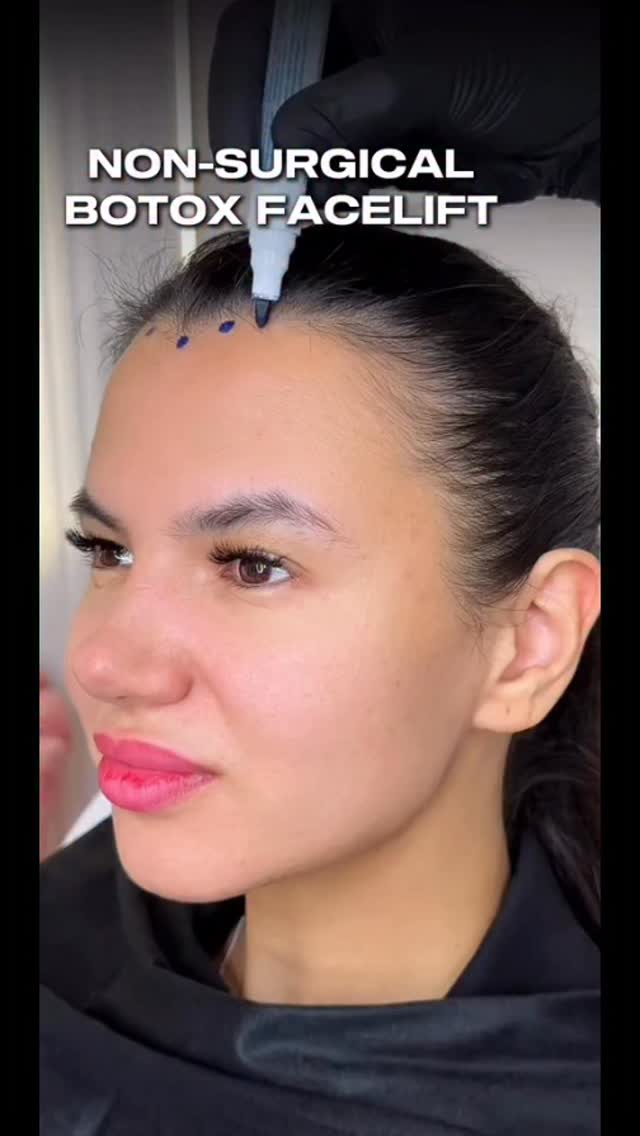 Botox lifting face no surgery
At R&R Beauty Clinic
#botox #botoxlifting #forheadbotoxinjection