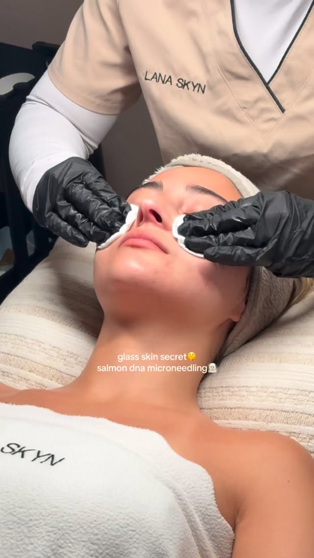 SKYNFORMULA™ is Lana Skyn’s signature microneedling treatment combined with Salmon DNA (polynucleotides/PDRN). The treatment focuses on improving overall skin quality by stimulating collagen production while supporting the skin barrier and natural repair process.
During the treatment, tiny microchannels are created in the skin through microneedling. The Salmon DNA serum is then infused deeper into the skin, where it helps with hydration, skin recovery, elasticity, and texture.
SKYNFORMULA™ is suitable for:
* acne scars
* fine lines
* dull or dehydrated skin
* enlarged pores
* uneven texture
* skin that feels tired or stressed
The goal is healthy, strong skin with a natural glow — not an overdone look. Results develop gradually over the weeks as the skin renews itself and builds new collagen.
At Lana Skyn, SKYNFORMULA™ is customized to the skin’s needs, whether the focus is hydration, texture, scarring, or overall skin maintenance.