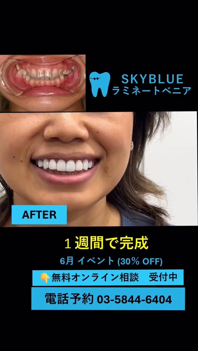 \🎁1本53900円、追加料金なし!!🦷日本で受けられるラミネート治療!/
SKYBLUEラミネートべニアで若返り:)
※6月30日までご来院の方対象│30%割引実施中✨
「前歯の形を整えたい」
「短期間で歯列を改善したい」
「ホワイトニングでも白くならない歯が悩み…」
そんな方は、
SKY BLUE歯科のラミネートで
自然歯への負担に配慮しながら、
自信の持てる口元を目指してみませんか?
【📝モニター価格適用条件】
1. Before&After撮影同意
2. 院内コンテンツ撮影同意
※お顔はモザイク処理を行います
30代 女性
治療期間 11日(最短7日で可)
治療費用 1本46200円×8本
考えられる副作用 ベニアが割れる・剥がれるの可能性、虫歯・歯周病のリスク、歯の神経へのダメージの可能性
#ラミネートベニア #無削除ラミネート #審美歯科 #セラミック治療 #歯を削らない #口元美容 #歯並び改善 #歯科医院 #矯正歯科 #文京区 #春日駅 #後楽園駅