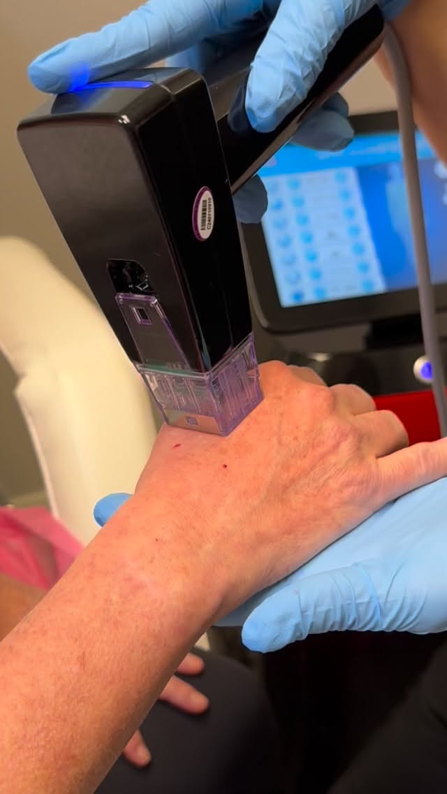 Hands often show signs of aging before the face does. Loss of collagen, thinning skin, crepey texture, visible veins, sun damage, and age spots can all make hands appear older than we feel.
In this video, I’m performing a Genesis RF Microneedling treatment on the hands to stimulate collagen and elastin production deep within the skin. This treatment helps improve skin texture, firmness, elasticity, and overall skin quality while creating a more youthful appearance over time.
✨ Benefits of Genesis RF Microneedling for Hands:
✔ Stimulates collagen & elastin production
✔ Improves crepey skin texture
✔ Firms and tightens aging skin
✔ Softens fine lines and wrinkles
✔ Improves overall skin quality
✔ Helps create smoother, more youthful-looking hands
💰 Special Offer:
Genesis RF Microneedling Hands – $249 per treatment
Purchase a package of 3 treatments and receive 20% OFF when you mention this video.
Because your hands deserve the same attention as your face. 🤍
📍 Elevate By Emilie
Message us to schedule your consultation.