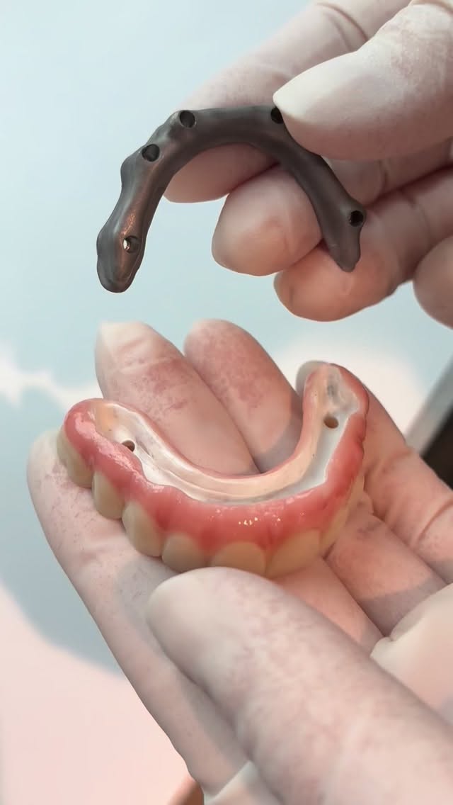 Not your average tooth fairy - our IPS e.max PRIME Full Arch with Gradient Technology, layered gingival architecture and a high precision Titanium Bar Substructure that slips into place without effort is exactly the sort of wizardry (really, just knowledge, skill, and expertise) that puts Precision Esthetics above the competition. Send us a case. Experience Amazing!