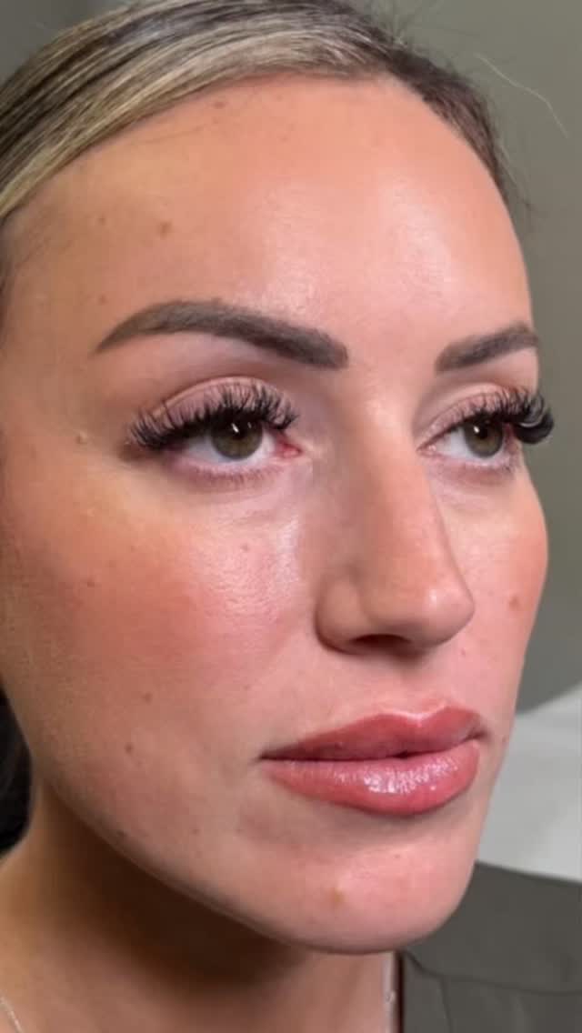 🤍✨ LIP BALANCING OVER VOLUME ✨☀️
Lip filler isn't always about making lips bigger. It's about creating balance, improving symmetry, and enhancing your natural features through precise placement.
The most beautiful results are often the ones that look refined, elegant, and effortlessly polished. Looking balanced will always be more timeless than chasing volume alone.
#lipbalancing #lipfillerswarrington #naturallips #aestheticswarrington #lipenhancement